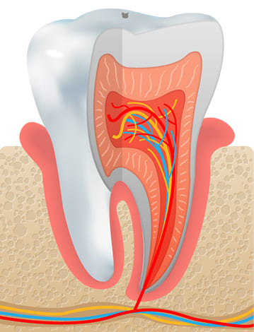 虫歯の最初期 C0（脱灰）