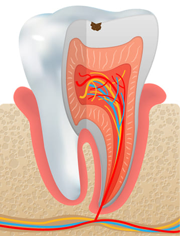 虫歯の初期 C1（歯の表面の虫歯・エナメル質）