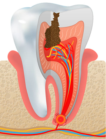 虫歯の末期 C4（歯の根まで進行した虫歯）