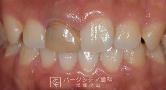 インプラント治療 ルートメンブレンテクニック