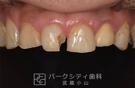 ジルコニアクラウンレイヤリングで修復