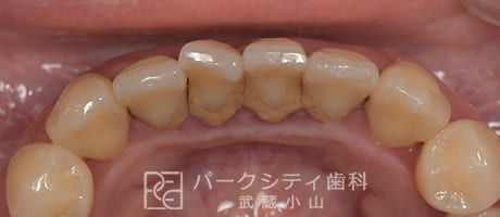 歯石が溜まっている状態