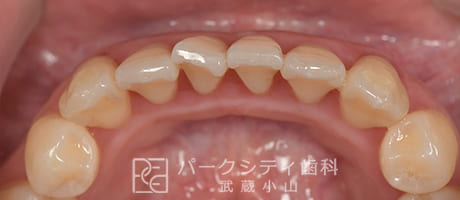 歯石除去1週間後