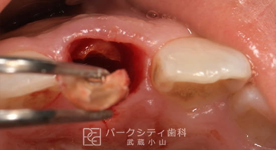 ルートメンブレンテクニックを併用した前歯部抜歯即時インプラント抜歯