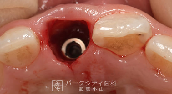 ルートメンブレンテクニックを併用した前歯部抜歯即時インプラント術中