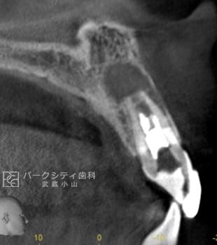 ルートメンブレンテクニックを併用した前歯部抜歯即時インプラント術前CT画像