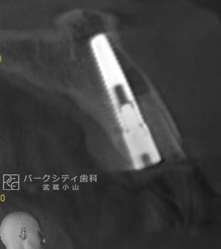 ルートメンブレンテクニックを併用した前歯部抜歯即時インプラント術中CT画像
