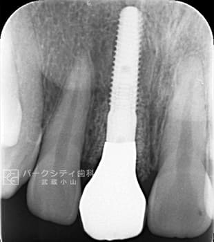ルートメンブレンテクニックを併用した前歯部抜歯即時インプラント術後CT画像