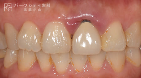 前歯部を抜歯即時でインプラント治療術前