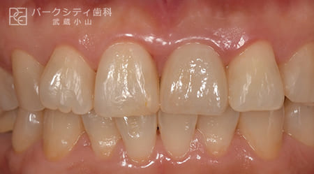 前歯部を抜歯即時でインプラント治療術後1年