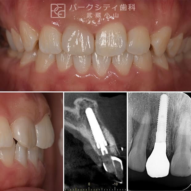 前歯部のインプラント治療におけるポイント
