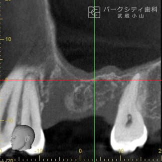 GBR法（骨誘導再生法）術前