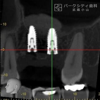 GBR法（骨誘導再生法）インプラント治療術後