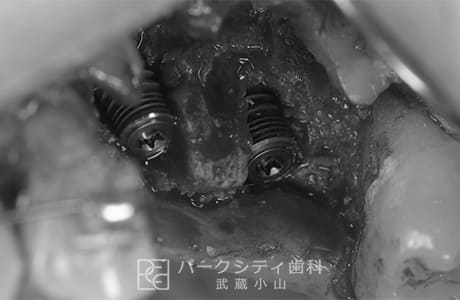 インプラント埋入