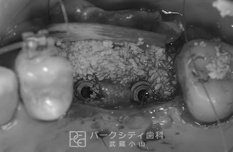 GBR法（骨誘導再生法）