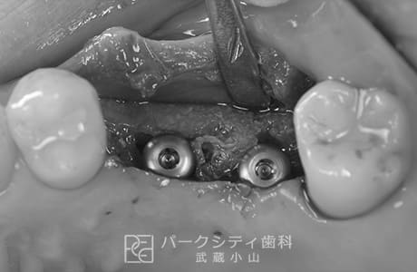 GBR法（骨誘導再生法）完了