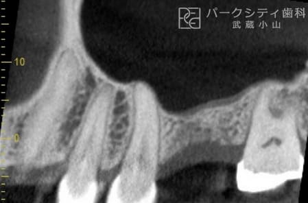 上顎洞挙上術・インプラント治療術前