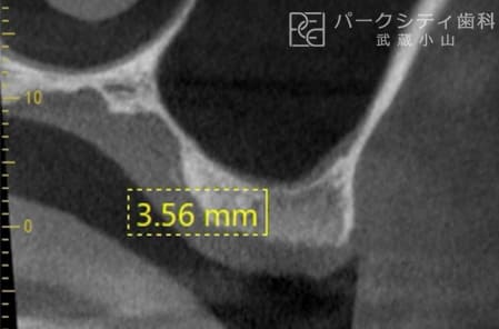 上顎洞挙上術・インプラント治療術前