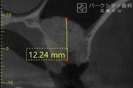 上顎洞挙上術・インプラント治療術中