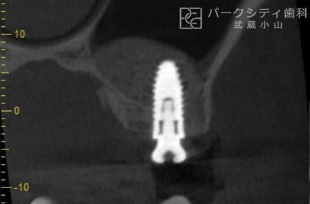 上顎洞挙上術・インプラント治療術後