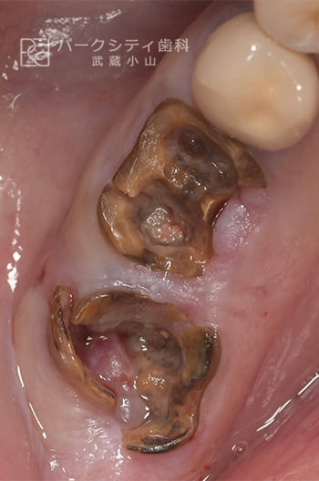 臼歯部を抜歯即時でインプラント治療術前