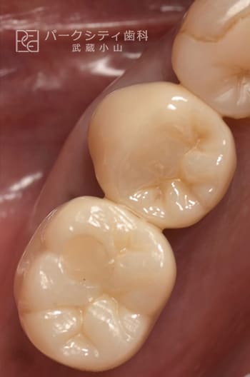 臼歯部を抜歯即時でインプラント治療術後