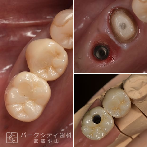 抜歯即時インプラントで、治療期間を大幅短縮