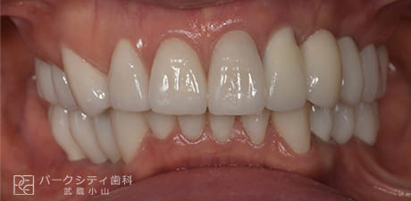 矯正とインプラント治療の術後