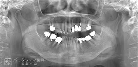 矯正とインプラント治療の術前レントゲン写真