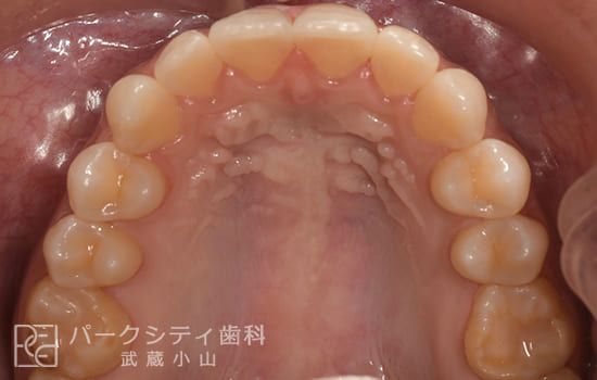 上顎部分矯正術後