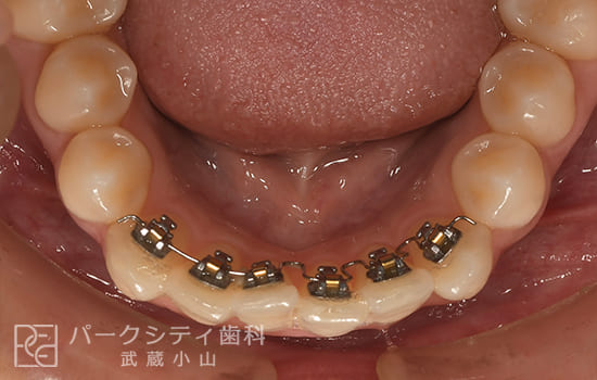 下顎部分矯正術前