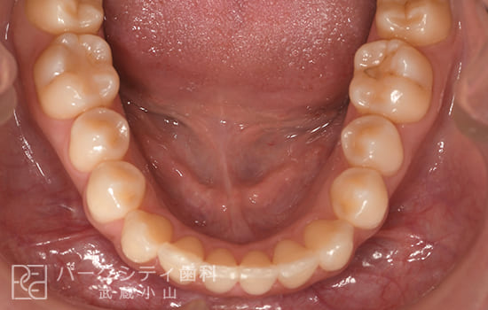 下顎部分矯正術後