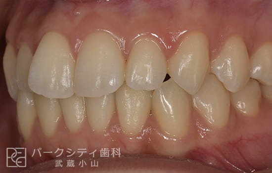 左側面部分矯正術前