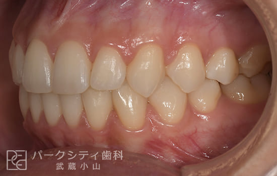 左側面部分矯正術後