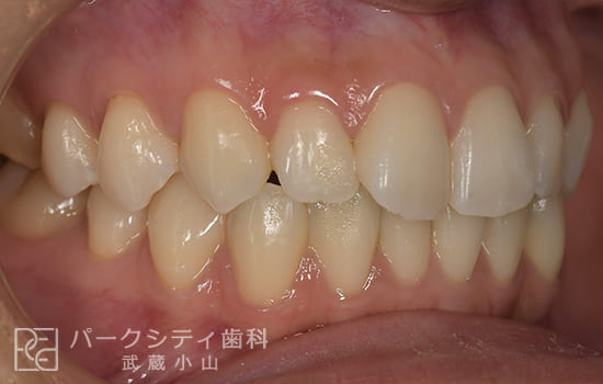 右側面部分矯正術前