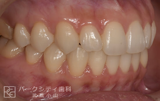 右側面部分矯正術後