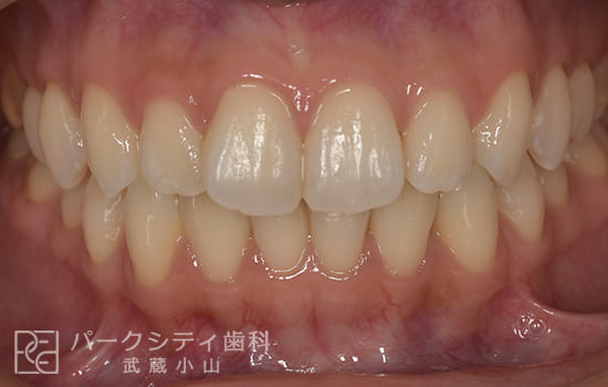 正面観リンガル舌側矯正術前