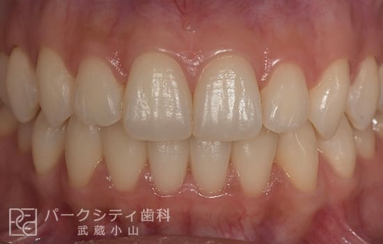 正面観リンガル舌側矯正術後