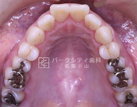上顎ハーフリンガルでの抜歯矯正術前