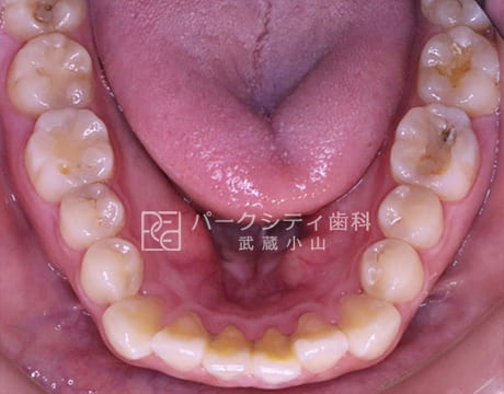 上顎ハーフリンガルでの抜歯矯正術前