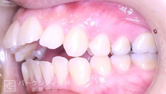左側面ハーフリンガルでの抜歯矯正術前