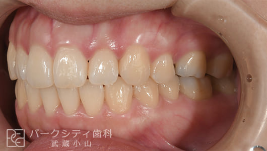 左側面ハーフリンガルでの抜歯矯正術後