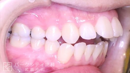 右側面ハーフリンガルでの抜歯矯正術前