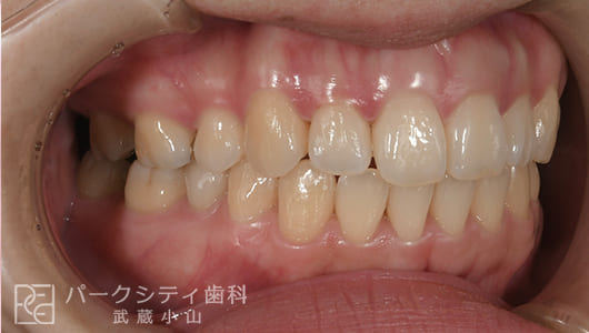 右側面ハーフリンガルでの抜歯矯正術後