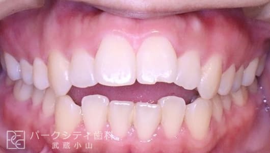 正面観ハーフリンガルでの抜歯矯正術前