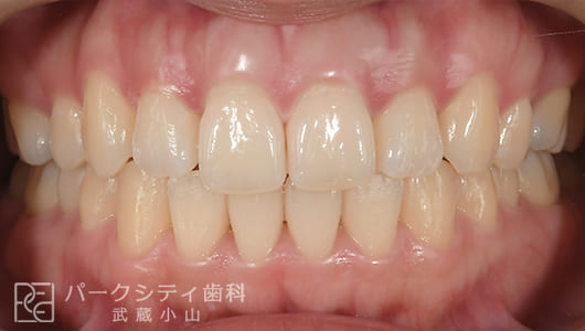 正面観ハーフリンガルでの抜歯矯正術後
