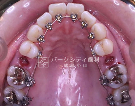 上顎ハーフリンガルでの抜歯矯正術中