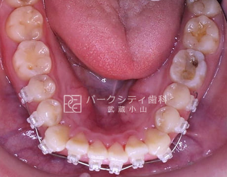 上顎ハーフリンガルでの抜歯矯正術中