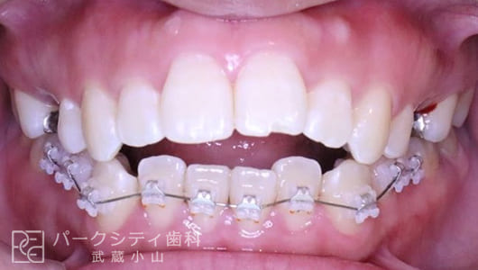正面観ハーフリンガルでの抜歯矯正術中