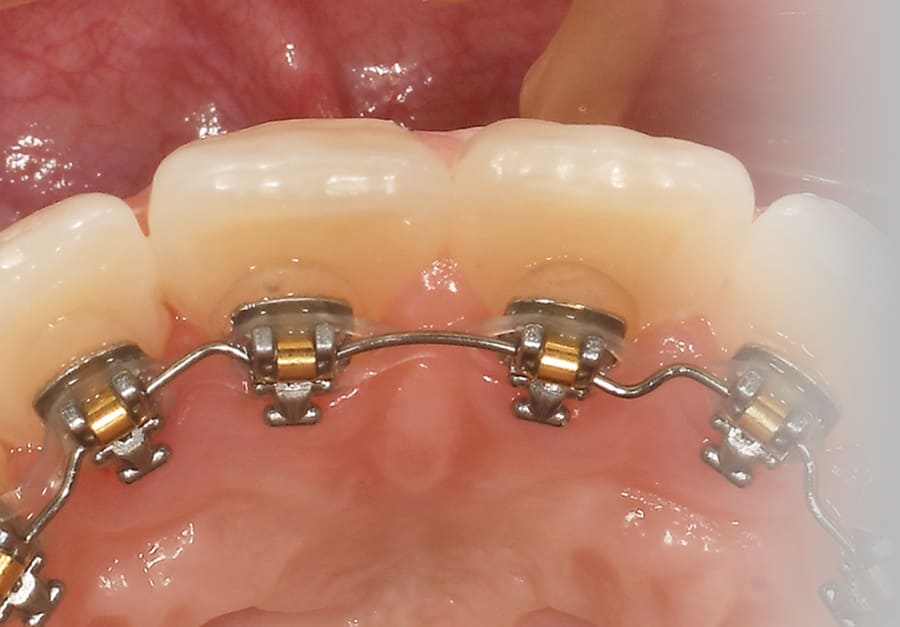裏側からの舌側矯正